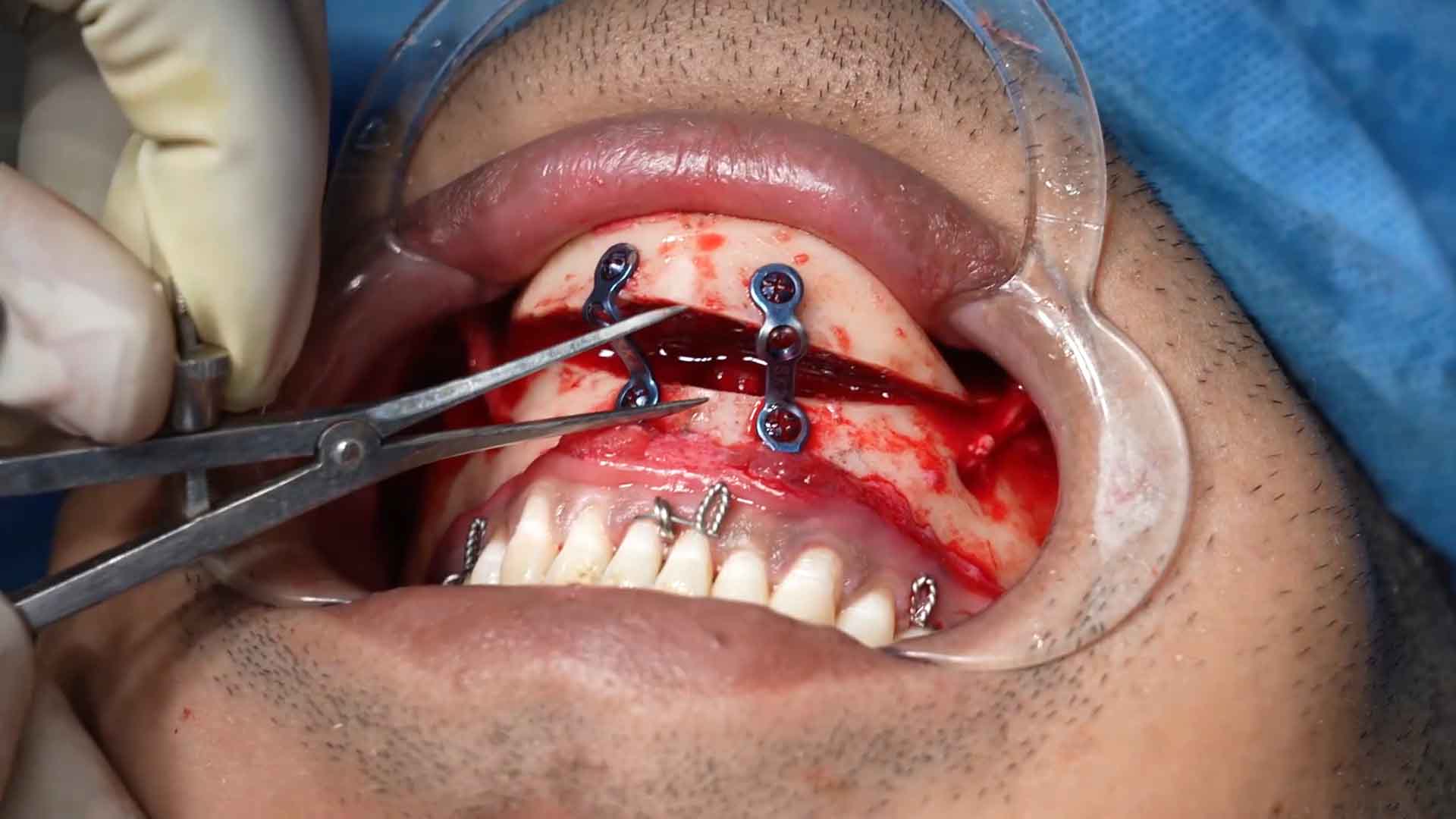 Upper and lower Jaw Surgery